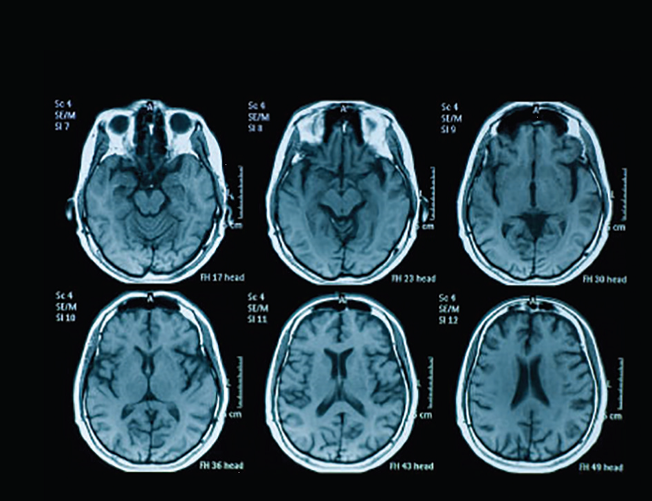 اسکن MRI دریچه ای رو به درمان و تشخیص اتیسم